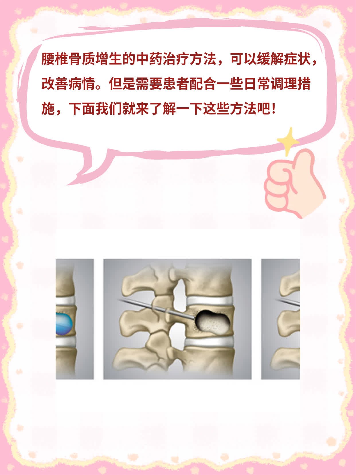 「揭秘」治疗腰椎骨质增生的中药方法