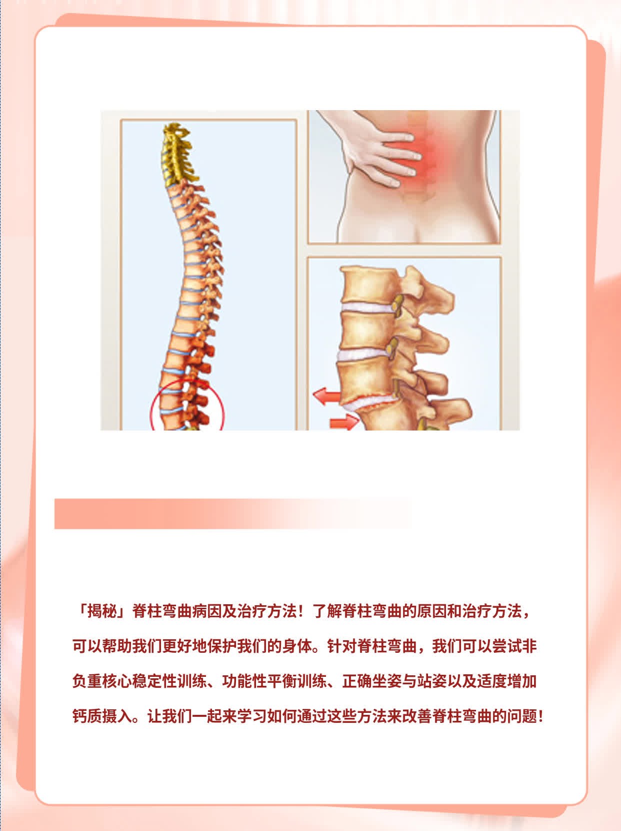 「揭秘」脊柱弯曲病因及治疗方法