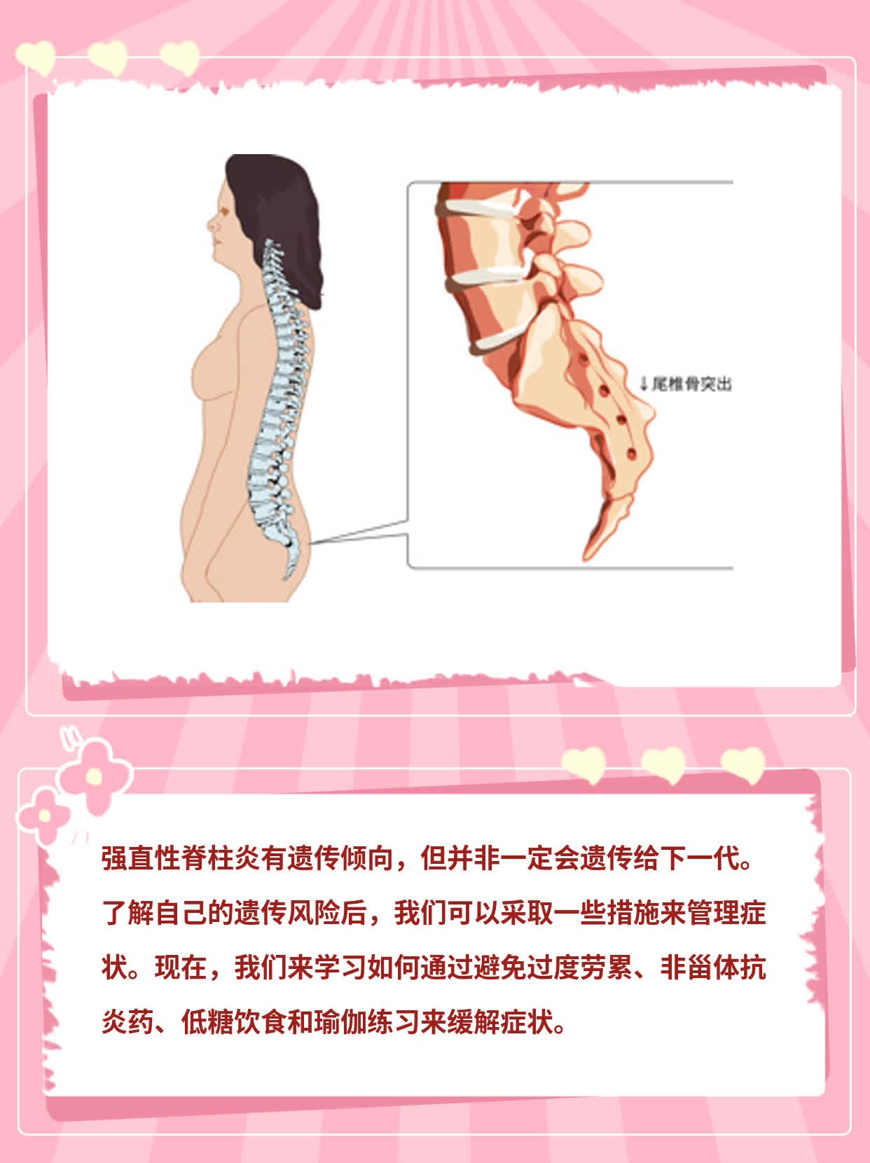 「强直性脊柱炎」：遗传风险解析