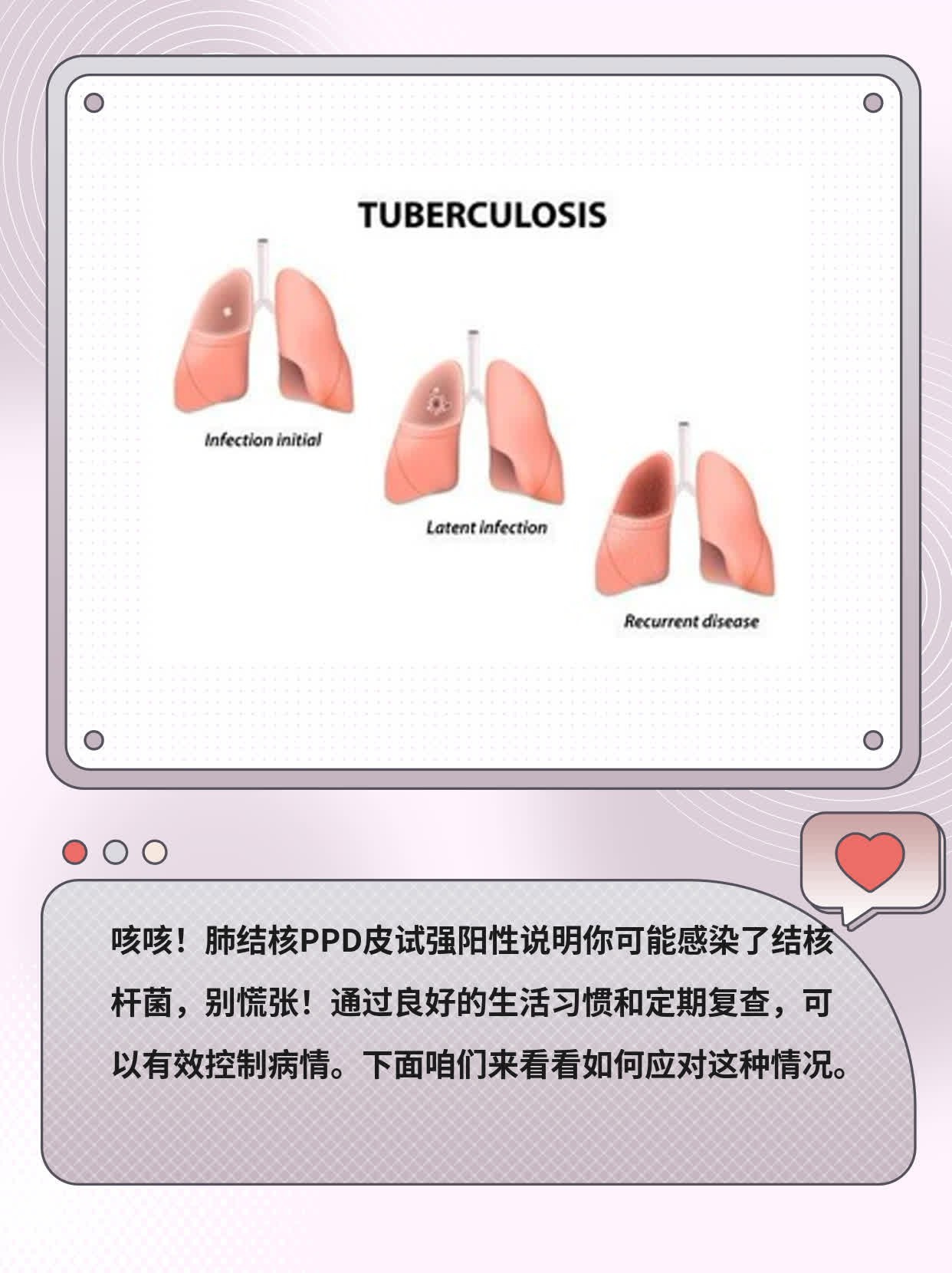 肺结核PPD皮试强阳？这可能是……