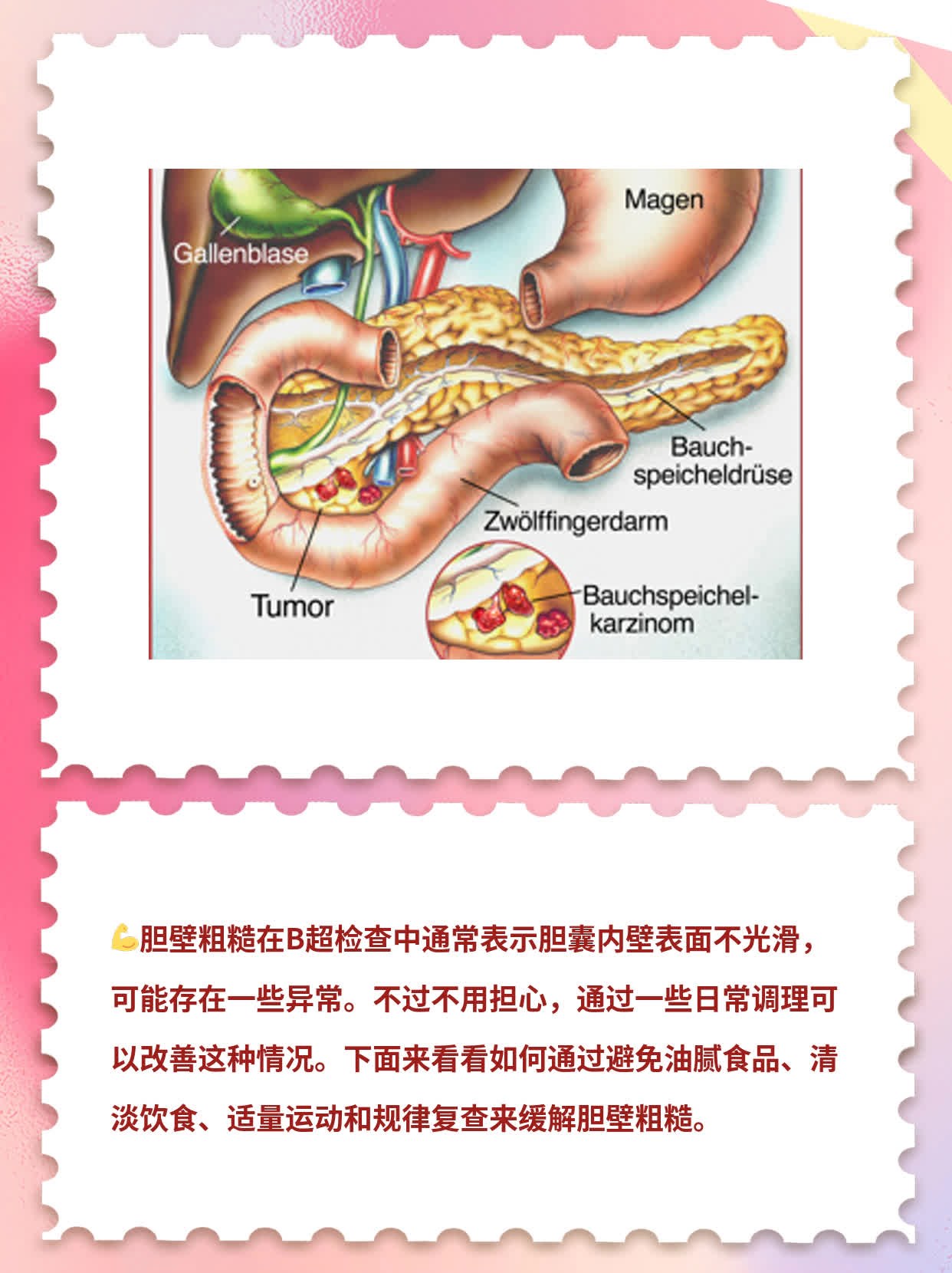 「胆壁粗糙」意味着什么？探秘B超检查中的高频词汇！