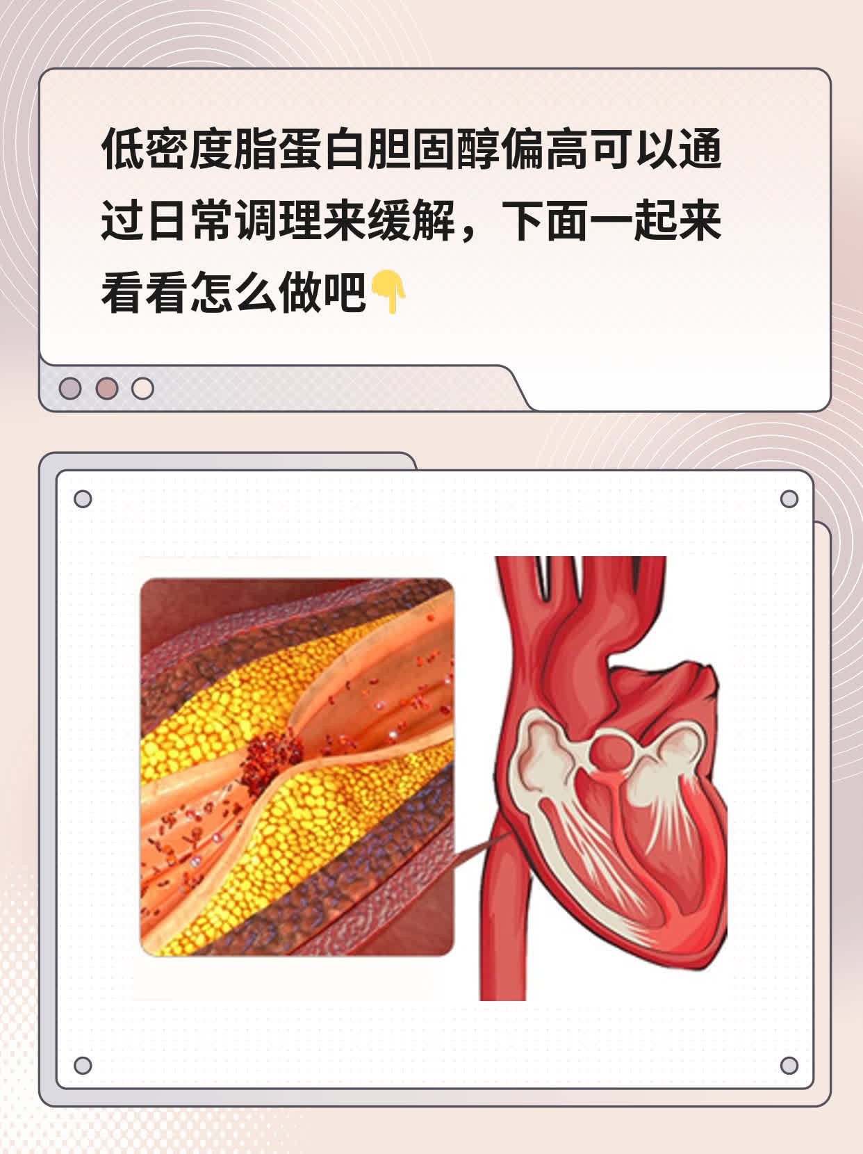 降LDL-C：高LDL-C的治疗攻略