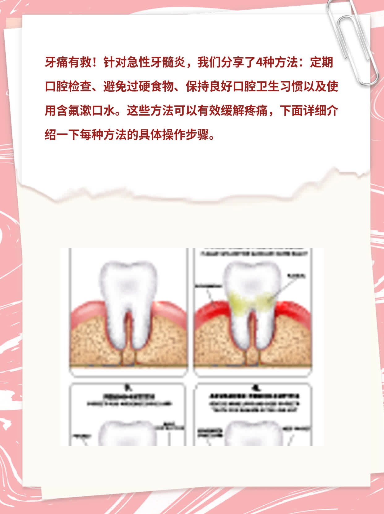 「牙痛有救」：急性牙髓炎的治疗方法分享