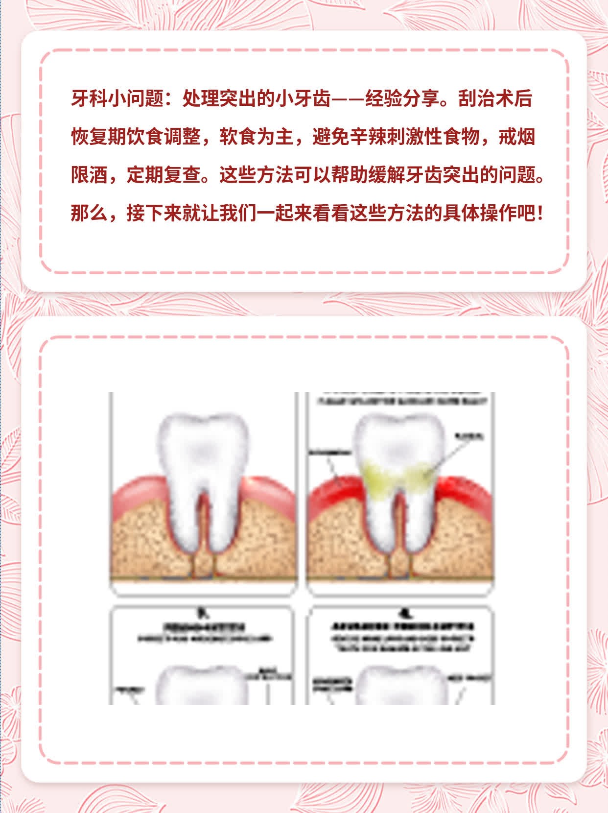 「牙科小问题」：处理突出的小牙齿——经验分享