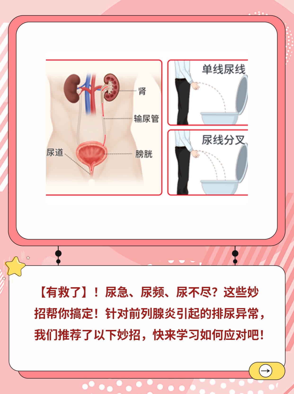 「有救了」！搞定尿急、尿频、尿不尽的妙招大全