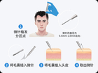 微针植发能维持多久