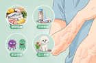 荨麻疹为什么会痒
