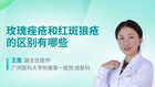 玫瑰痤疮和红斑狼疮的区别有哪些