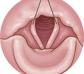 新生儿喉软骨图片