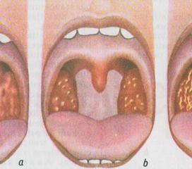 咽峡炎图片结构图图片