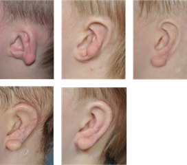 唐氏儿的耳朵特征图片