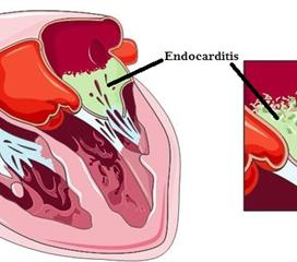 感染性心內膜炎