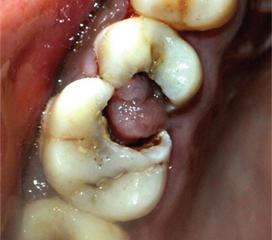 牙齿髓石图片