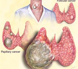 滤泡性甲状腺腺瘤图片图片