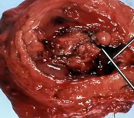 膀胱癌图片早期图片