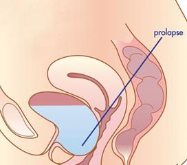 怀孕期间子宫脱垂图片图片