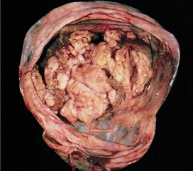 卵巢良性肿瘤图片图片