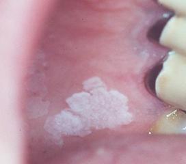 麻疹口腔黏膜白斑图片图片