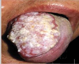 口腔乳头状瘤早期图片图片