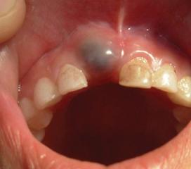 8岁儿童含牙囊肿图片