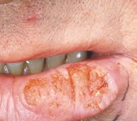 早期唇癌图片