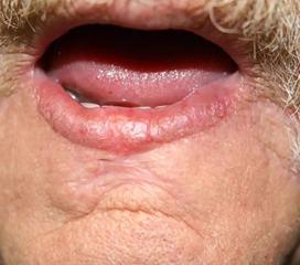 唇癌的症状图片图片