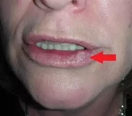 唇癌早期图片