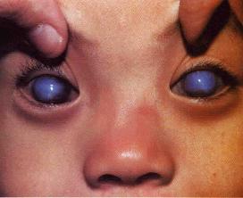 急性闭角性青光眼