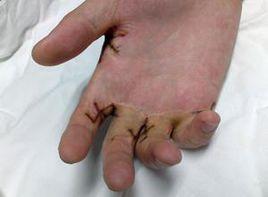 手掌筋膜炎图片
