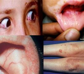 毛细血管扩张性共济失调综合征