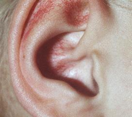 毛细血管扩张性共济失调综合征