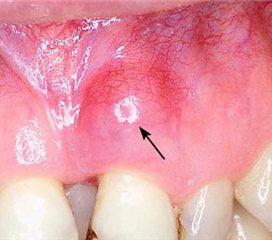 牙周脓肿图片 慢性图片