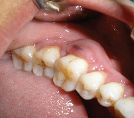 牙周脓肿图片 慢性图片