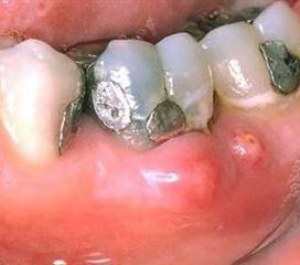 慢性牙槽脓肿图片