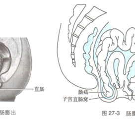 直肠膨出图片图片