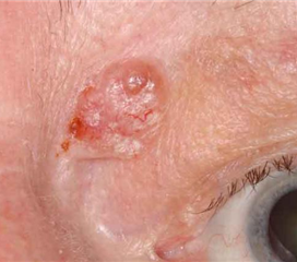 眼睑癌早期症状图片图片