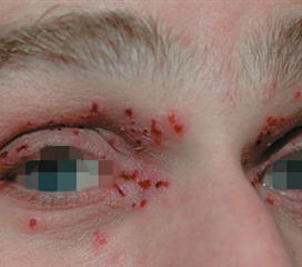 眼部病毒性疱疹图片图片