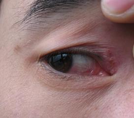 眼部带状疱疹症状图片