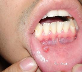 口腔粘液腺瘤图片