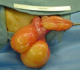 小肠血管畸形图片