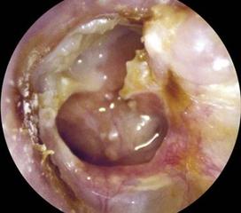 膽脂瘤型中耳炎