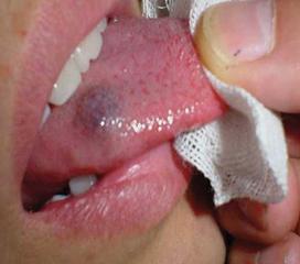 舌头海绵状血管瘤图片