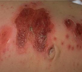 皮肤金色葡萄球菌症状图片