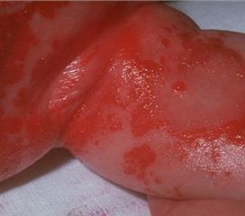 葡萄球菌性烫伤样皮肤综合征