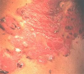 皮肤金色葡萄球菌症状图片