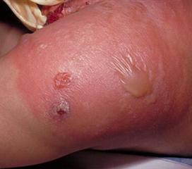 女性表皮葡萄球菌感染图片