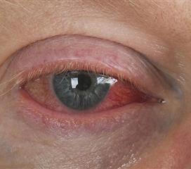 虹膜炎早期症状图片