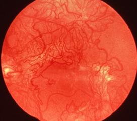 视网膜下新生血管膜