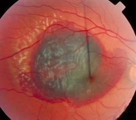 视网膜下新生血管膜