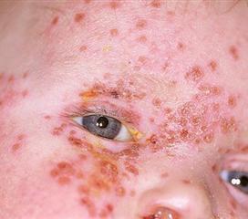 解脲支原体感染